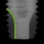 Radiograph showing apical grooves, outlined in green