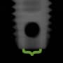 Radiograph showing open, outlined in green