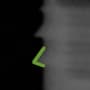 Radiograph showing reverse buttress, outlined in green