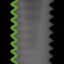 Radiograph showing threaded, outlined in green
