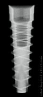 Radiograph of Cyclone Conical