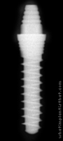 Radiograph of One-Piece Fix-Type