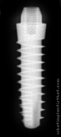 Radiograph of S-Type Transmucous Mono Phase 2.5mm Neck