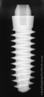 Radiograph of S-Type PX Mono Phase 2.5mm Neck