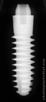 Radiograph of S-Type PX Mono Phase 4mm Neck