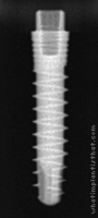 Radiograph of S-Type XT