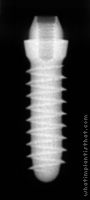 Radiograph of Tixos S-Type 1.8mm Neck
