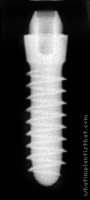 Radiograph of Tixos S-Type 2.8mm Neck