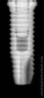 Radiograph of Anthofit HE Straight