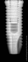 Radiograph of Anthofit HE Straight