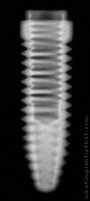 Radiograph of Osseous Mini