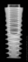 Radiograph of Osseous Quattro Standard
