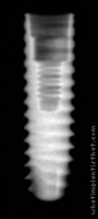 Radiograph of Axiom REG