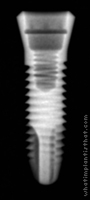 Radiograph of Ossfit Aesthetic