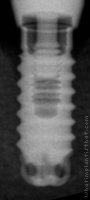 Radiograph of Periosave Classic Ocatagon