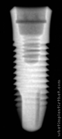 Radiograph of Ossfit Aesthetic