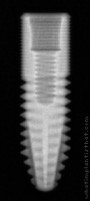 Radiograph of InHex Mini