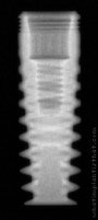 Radiograph of InHex Quattro Standard