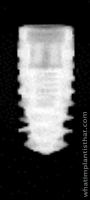 Radiograph of BLX Roxolid RB