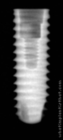Radiograph of Axiom REG