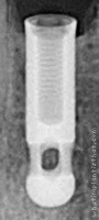 Radiograph of Internal Hex Cylindrical