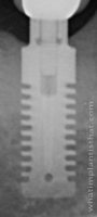Radiograph of Rex TL 2.9