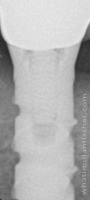 Radiograph of Bonelock