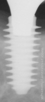 Radiograph of Anyridge D4