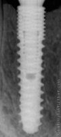 Radiograph of HG