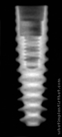 Radiograph of Axiom PX