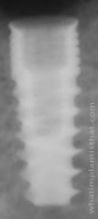 Radiograph of Dynamix