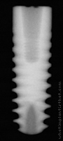 Radiograph of Friadent Ankylos