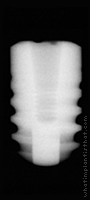 Radiograph of Friadent Ankylos