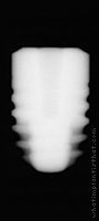 Radiograph of Friadent Ankylos