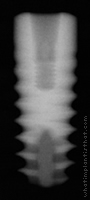Radiograph of Friadent Ankylos C/X
