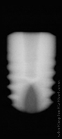 Radiograph of Friadent Ankylos C/X
