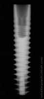 Radiograph of Friadent Ankylos C/X