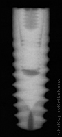 Radiograph of Friadent Ankylos