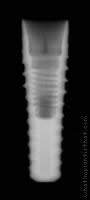 Radiograph of Implance | Bone Level 3.7