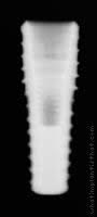 Radiograph of Implance | Bone Level 4.3