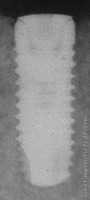 Radiograph of BioCom