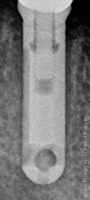Radiograph of BioVent