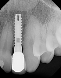 Radiograph of Miniplant