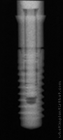 Radiograph of Bone Level NC