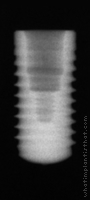 Radiograph of Bone Level RC