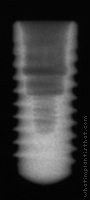 Radiograph of Bone Level RC