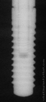 Radiograph of Bone Level NC