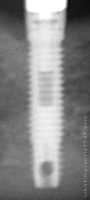 Radiograph of Branemark Mk III RP