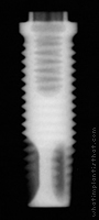 Radiograph of Branemark