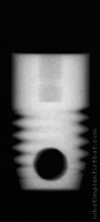 Radiograph of Screw Root Form